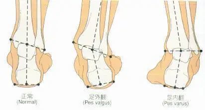 骨科医生提醒:千万别陷入这买鞋5大误区 五步选鞋法、正确量脚长方法